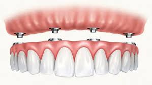 All On 4 Dental Implants vs. Traditional Dentures: A Comparison