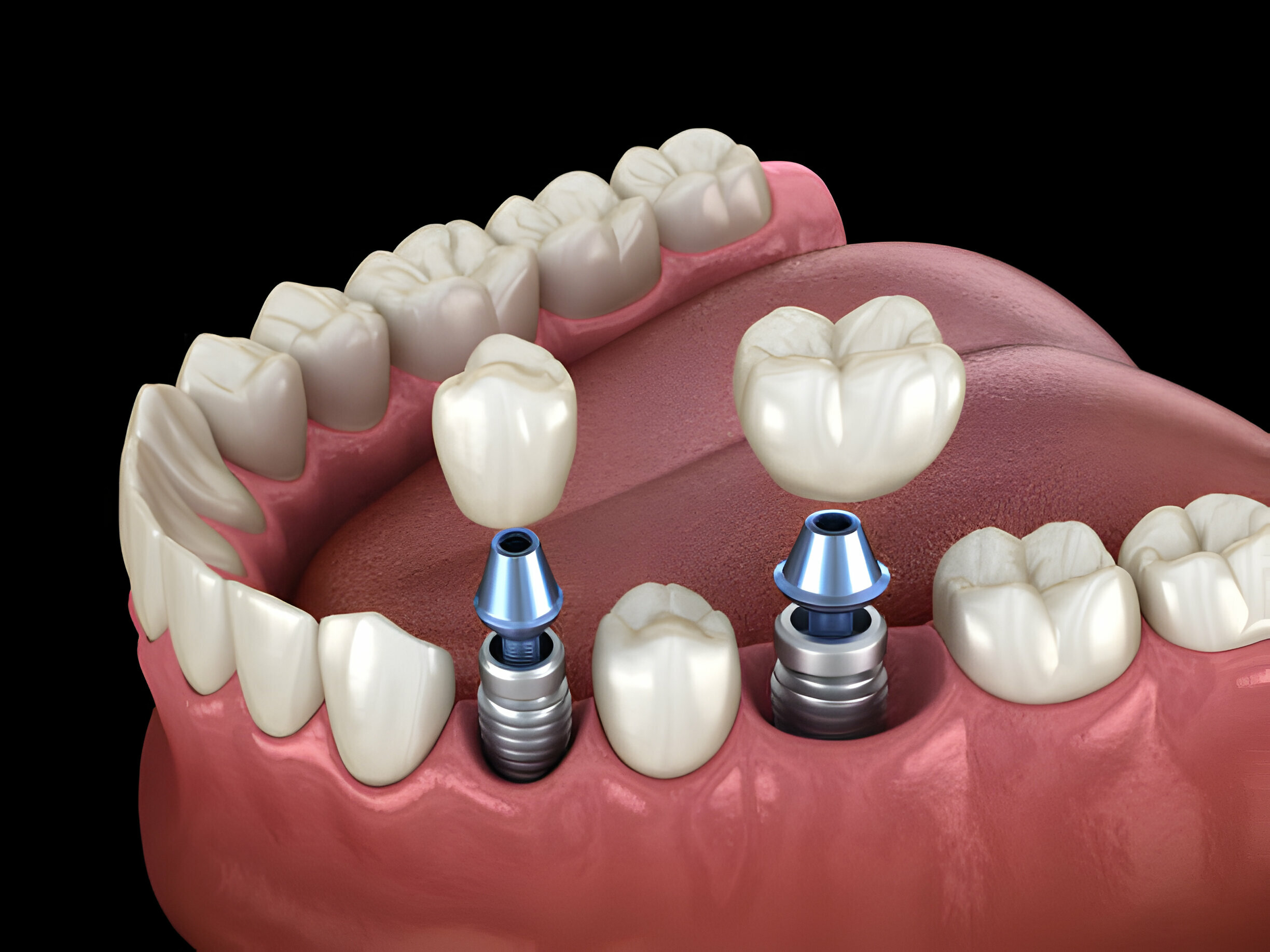 Multiple Implants Aberdeen