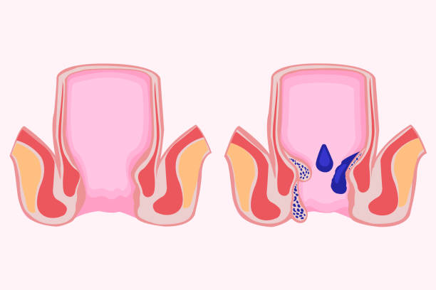 hemorrhoid treatments in Al Ain