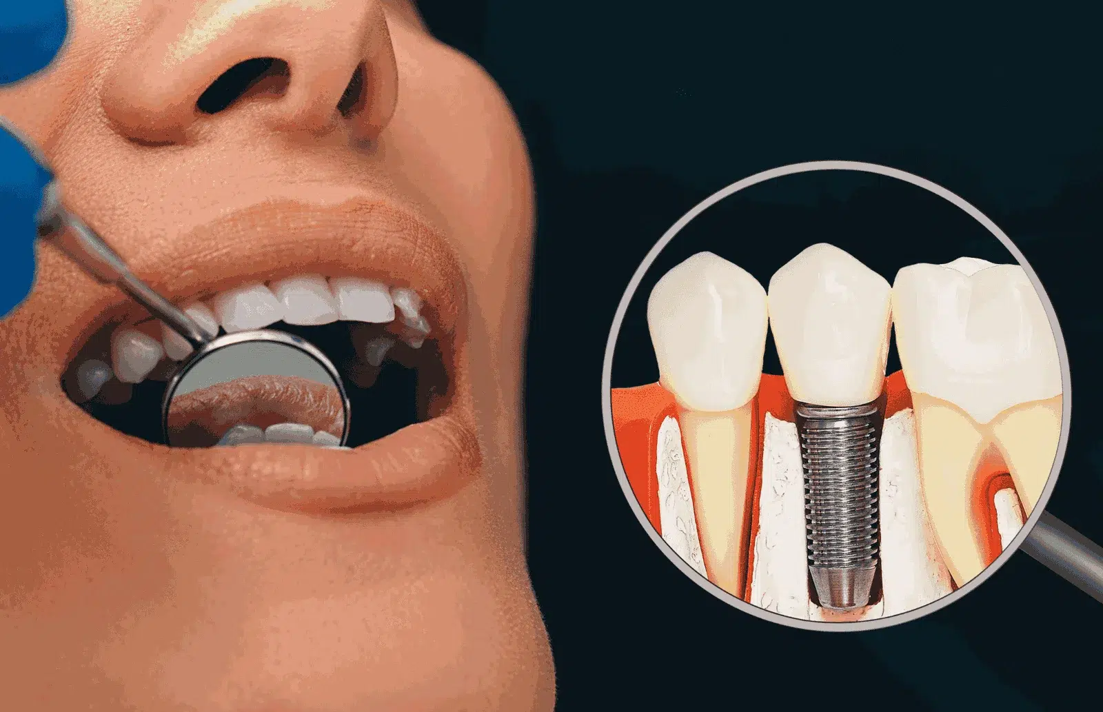 tooth implant services