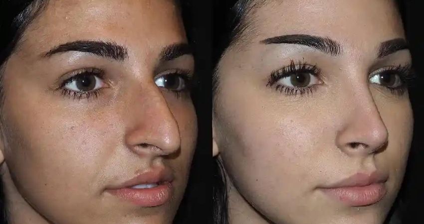 Can I Exercise After Rhinoplasty in Dubai?