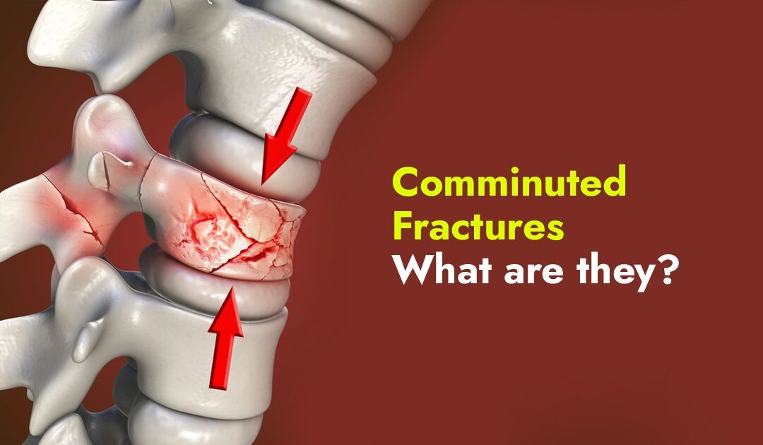 Comminuted Fracture