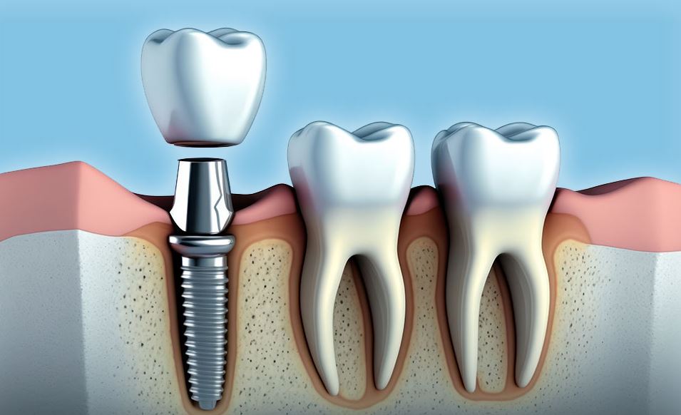 Dental Implants Post Treatment Care