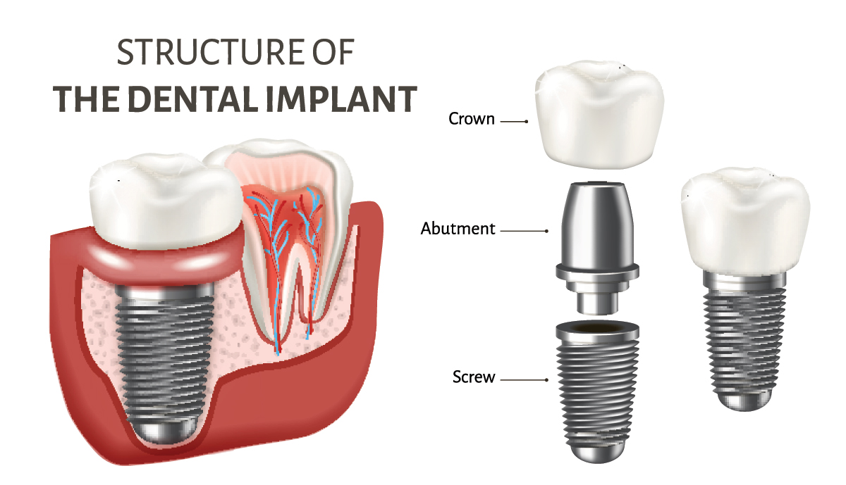 Dental Implants in Rhode Island