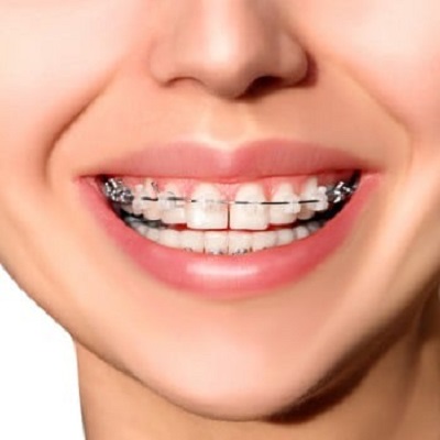 How to Choose the Right Dental Braces for Your Lifestyle