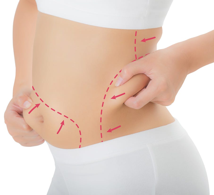 tummy tuck