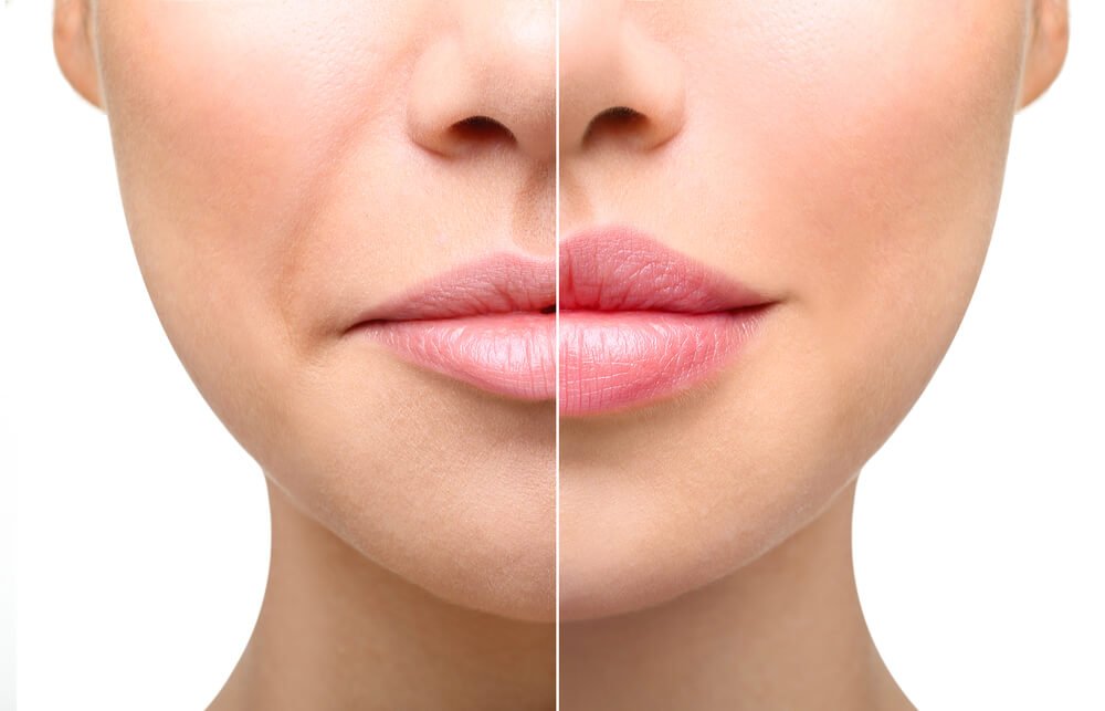 Signs You Might Need a Touch-Up After Lip Fillers