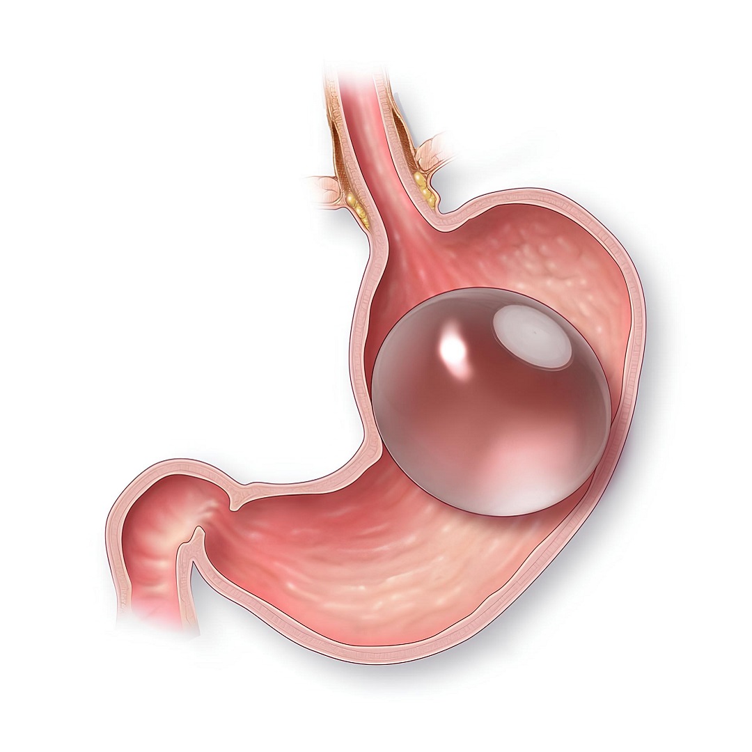 What Is The Working Of Gastric Balloon For Losing Weight?