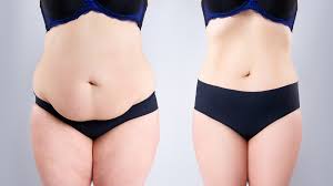 best tummy tuck surgeon ibest tummy tuck surgeon in houston texas