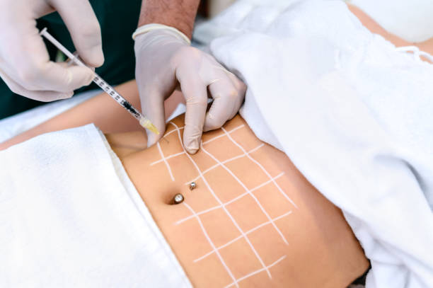 Liposuction surgery in Dubai