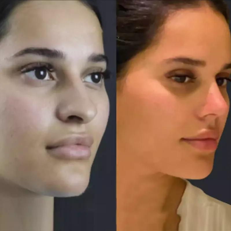 Why Rhinoplasty in Dubai is the Top Choice for Nose Reshaping