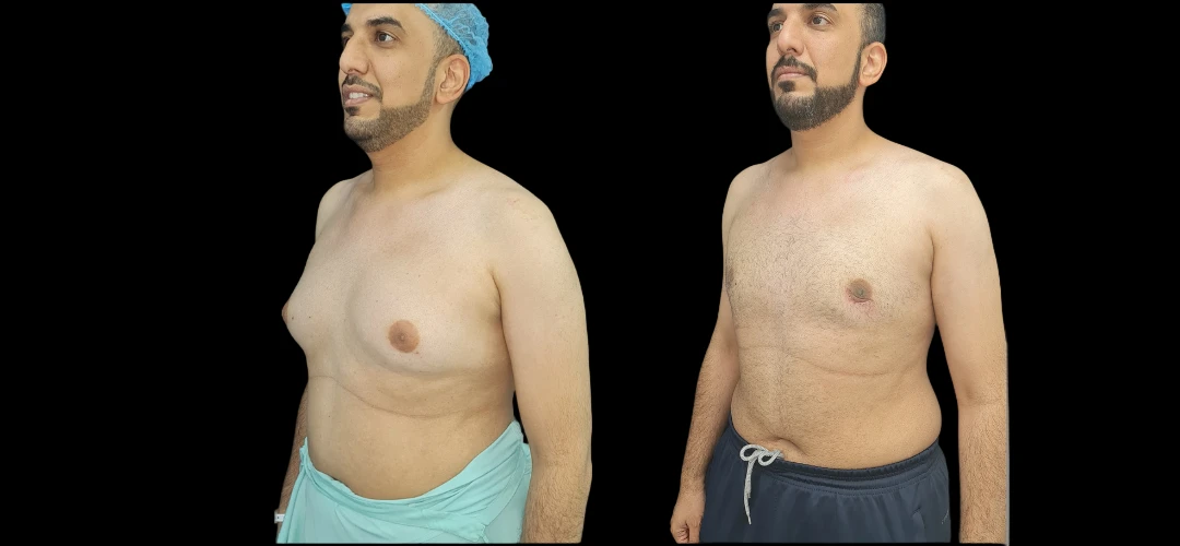 gynecomastia in dubai