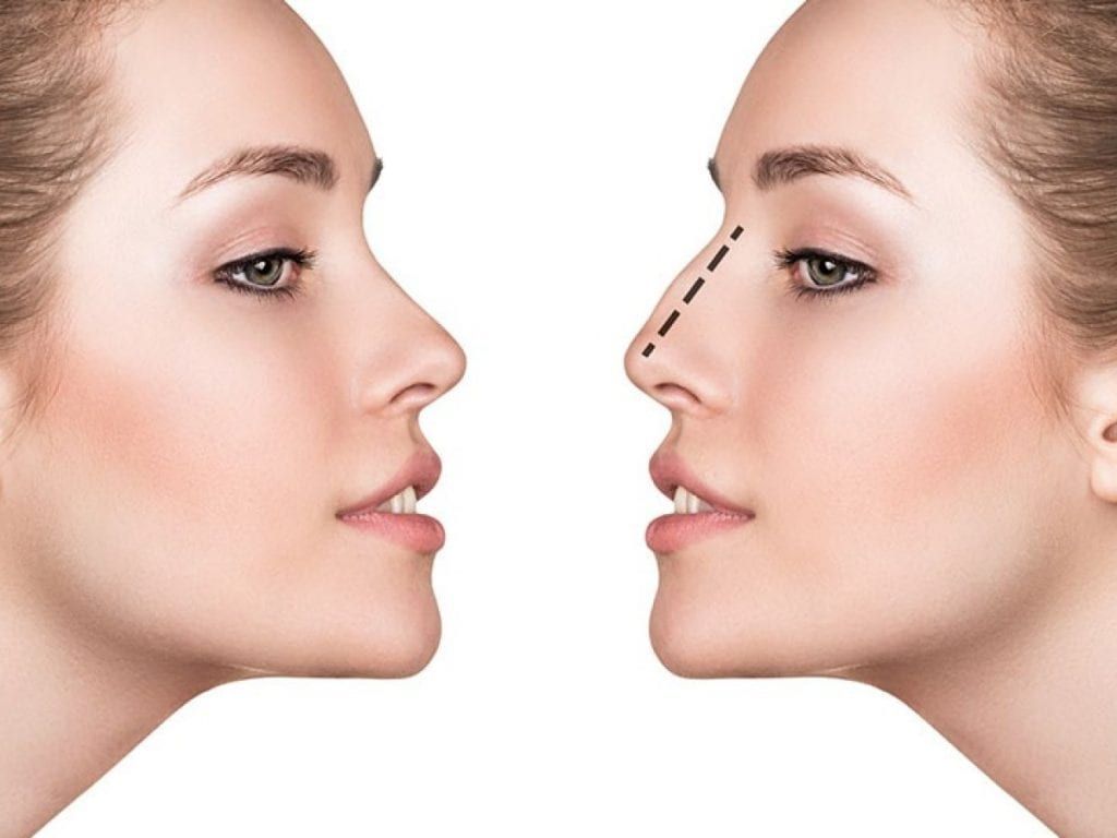 Rhinoplasty in Dubai (تجميل الأنف في دبي)