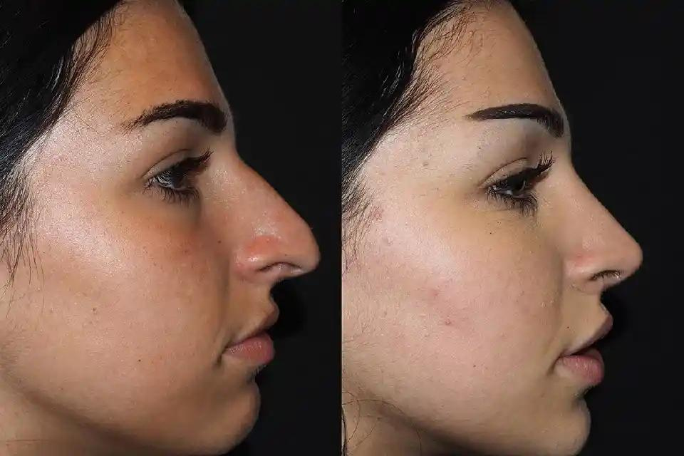 Exploring the Expertise of the Best Rhinoplasty Surgeons in Dubai: What Sets Them Apart