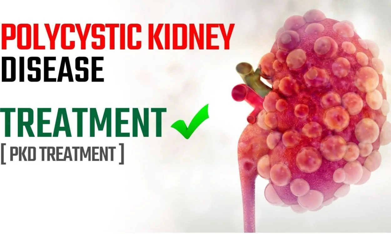 Discover the Best Polycystic Kidney Disease Treatment Plans for 2025