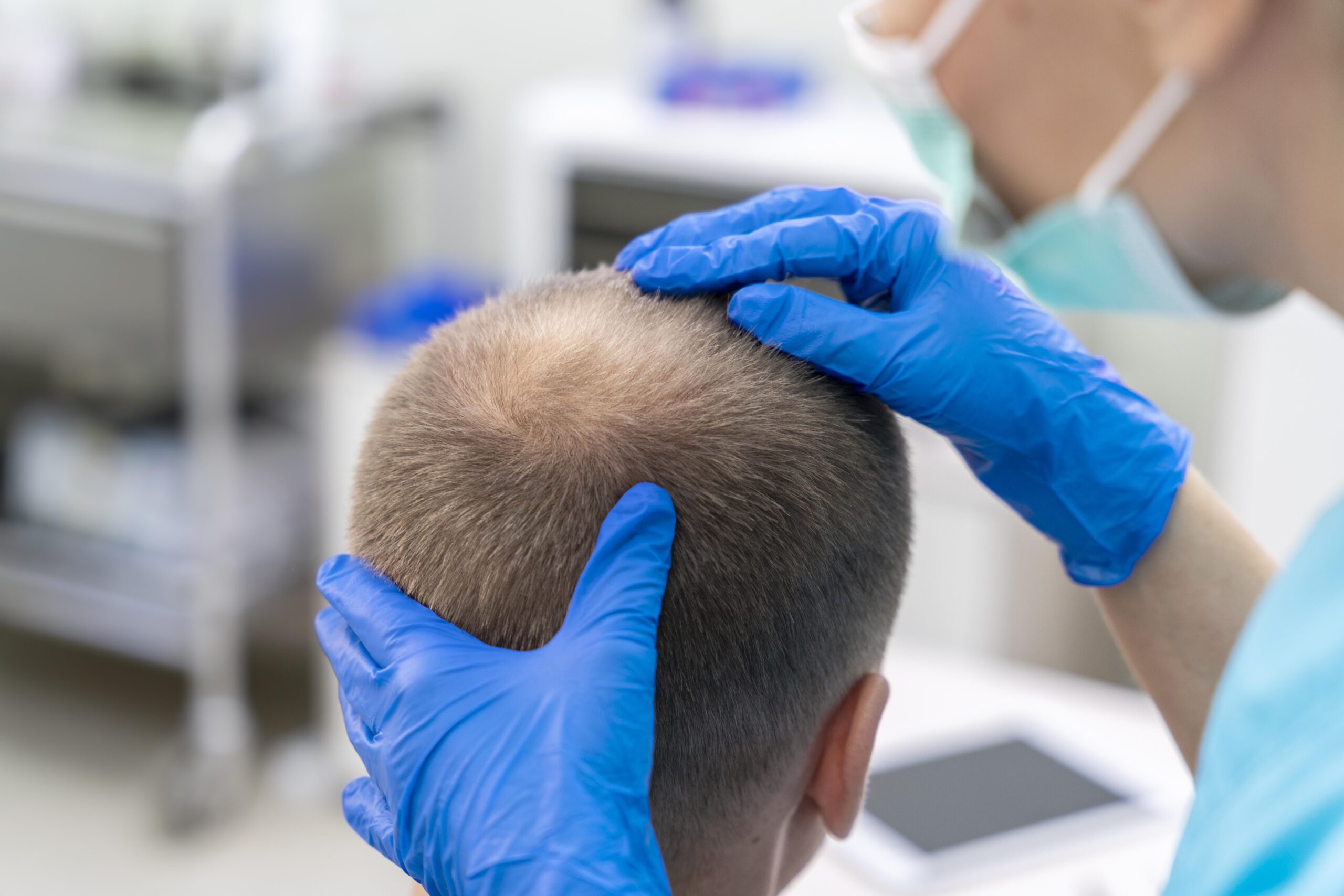 hair transplant cost in dubai (تكلفة زراعة الشعر في دبي)