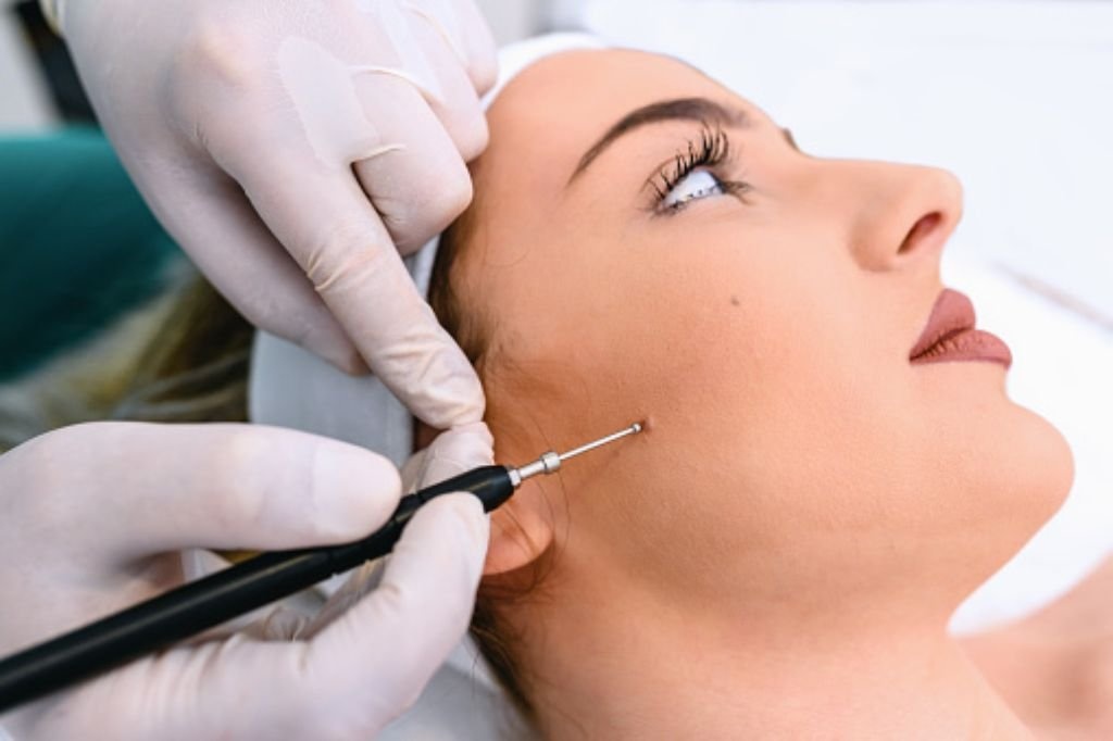 Mole removal in Dubai