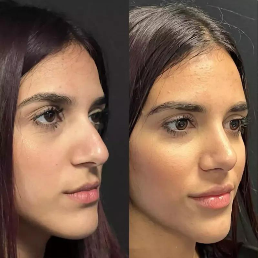 Rhinoplasty in Dubai: Combining Functionality and Aesthetic Excellence