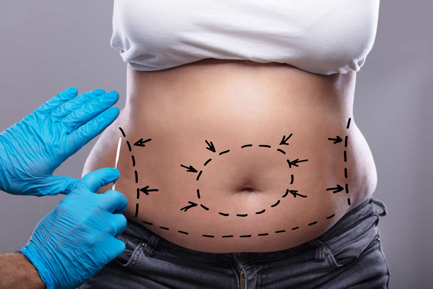 Best Tummy Tuck Surgeons in dubai