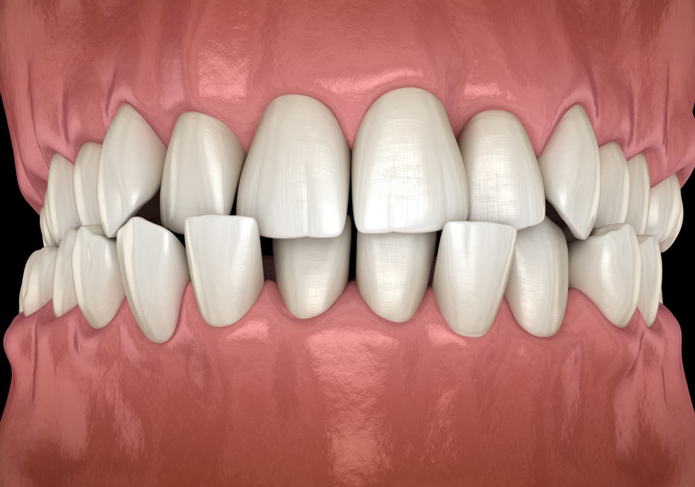 teeth bonding for gaps