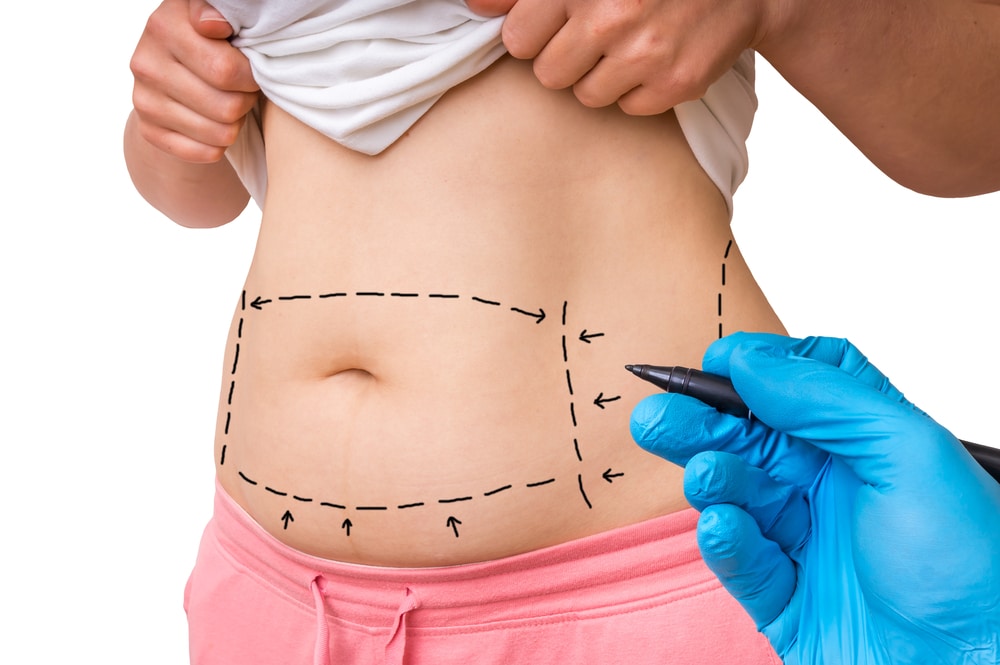 Tummy Tuck Surgery in dubai