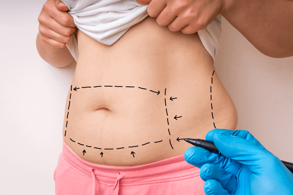 Tummy Tuck in Dubai