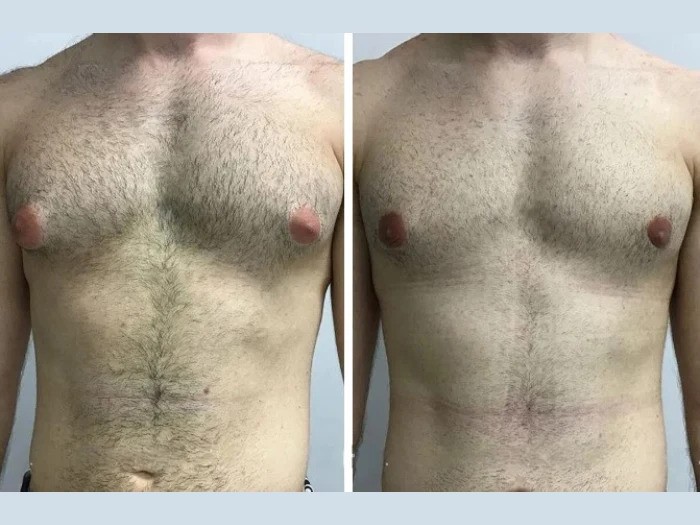 Best Doctors in Dubai for Gynecomastia Surgery