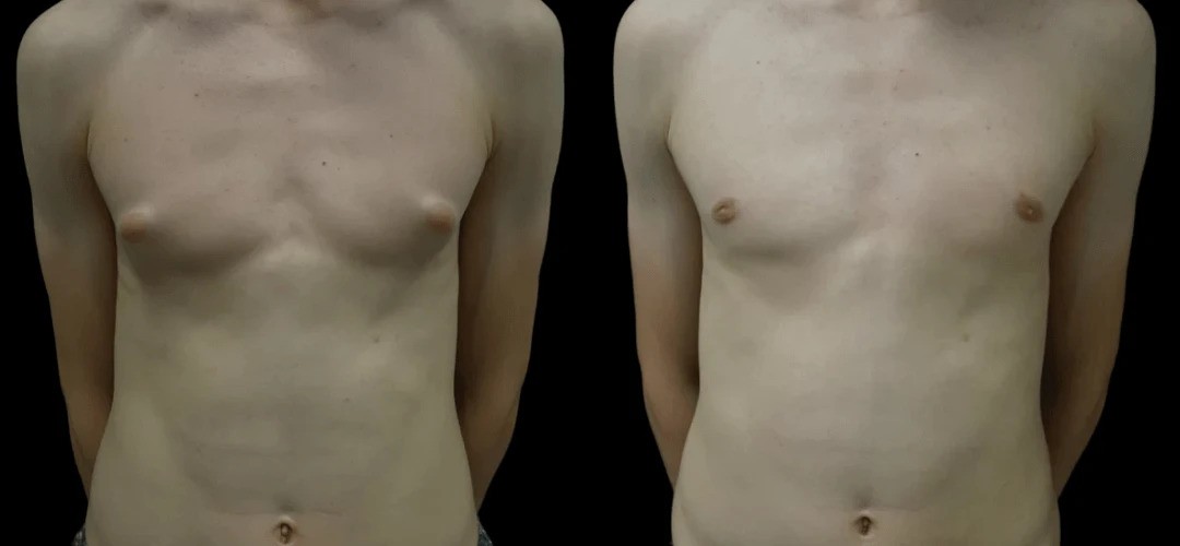 Best Gynecomastia Surgeon in Dubai