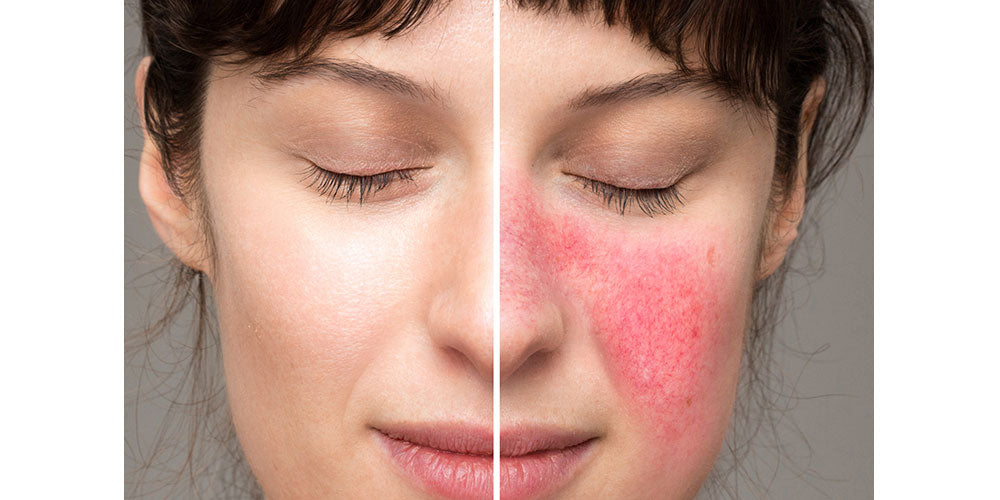 Is a Chemical Peel Good for Rosacea