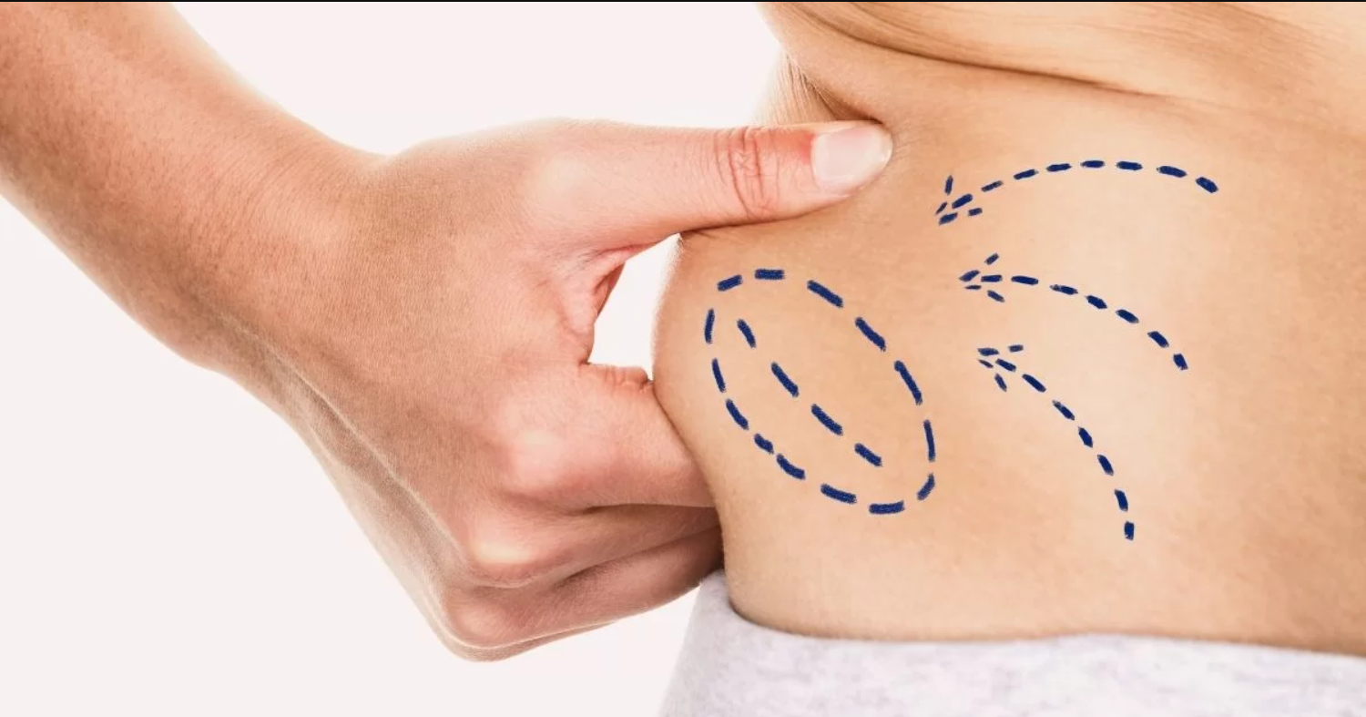 Best Liposuction Surgeon in Dubai