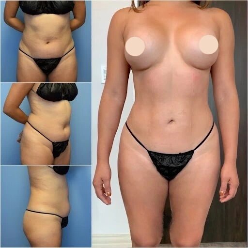 body contouring