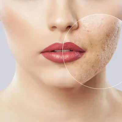 Acne Scars Treatment in Islamabad