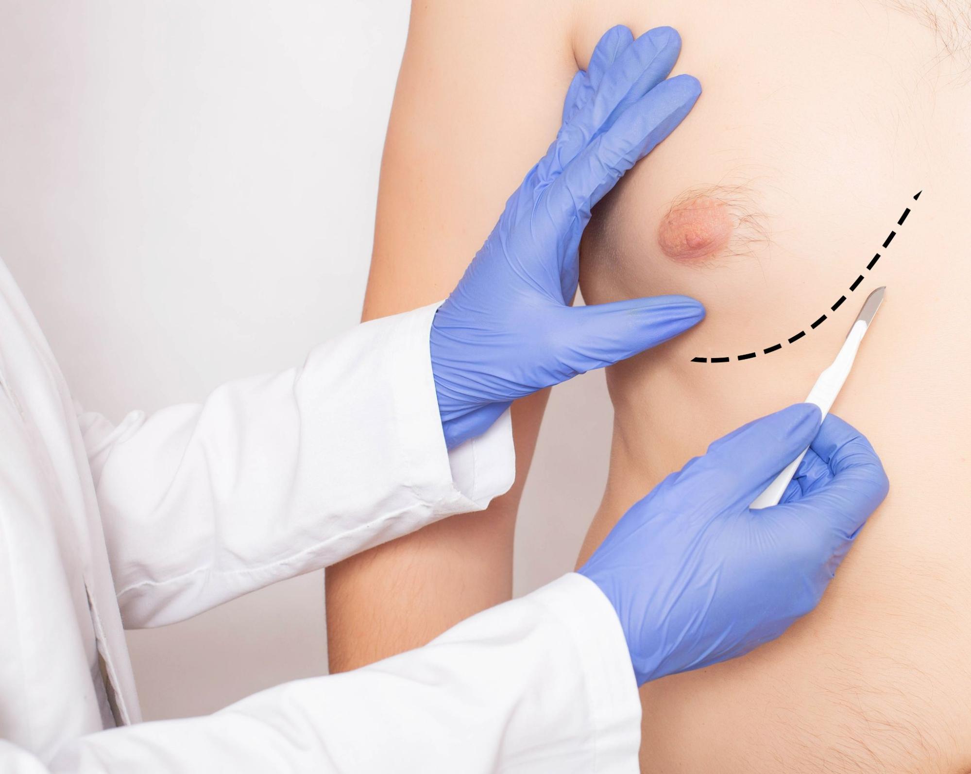 Gynecomastia surgery in Islamabad