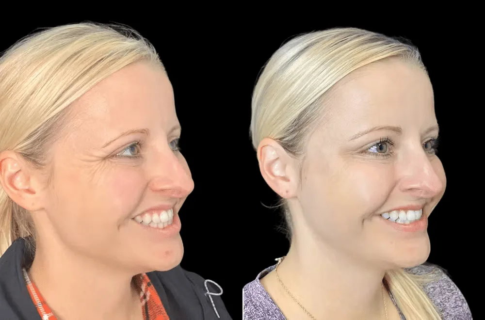 Botox in dubai