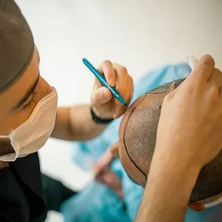 Hair Transplant in Islamabad