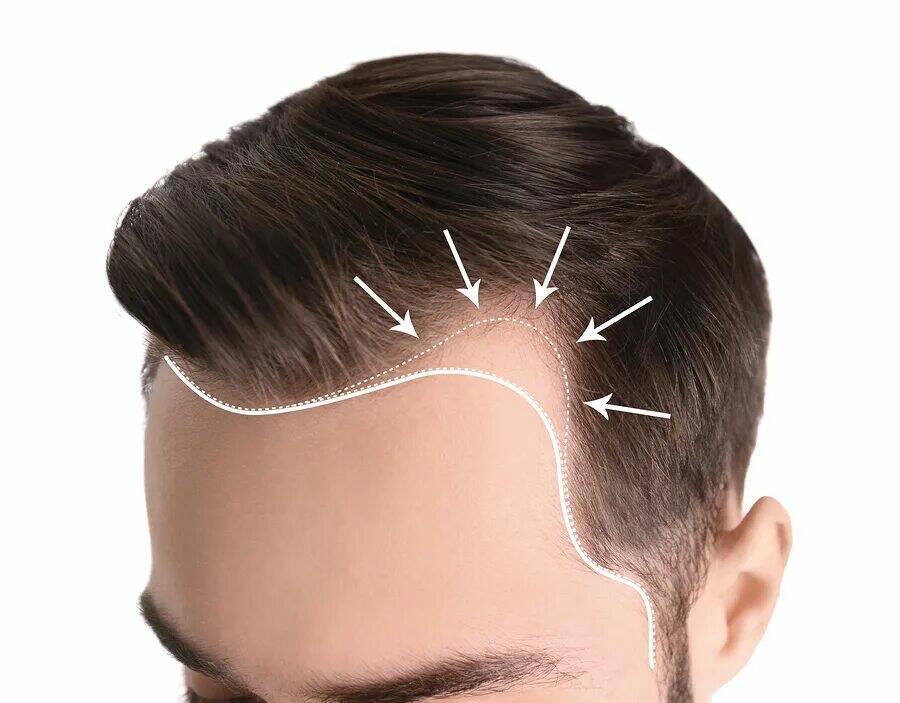 زراعة الشعر في دبي