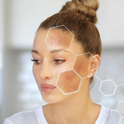 Melasma Treatment in Islamabad