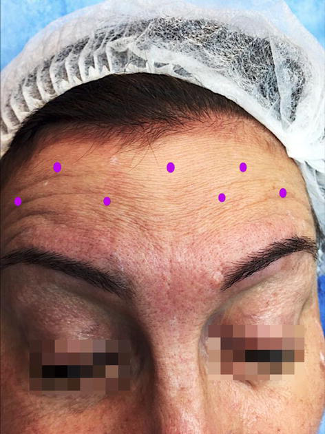Mikrobaby-Botulinumtoxin