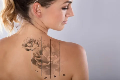 "laser tattoo removal in Islamabad" "laser tattoo removal in Islamabad-" "laser tattoo removal in Islamabad"