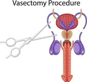 Vasectomy and Everyday Life